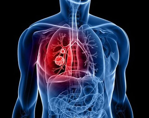 Paraziți în plămâni